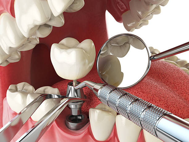 Best Emergency Denture Repair in Pinconning, MI